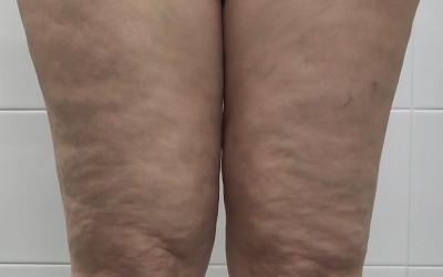 Lipedema: riconoscerlo, gestirlo e come possiamo aiutarti