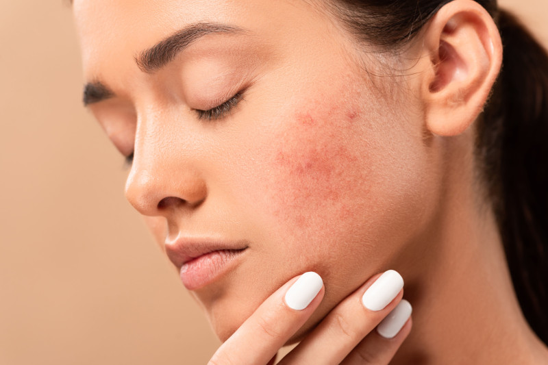 Acne attiva o cicatriziale